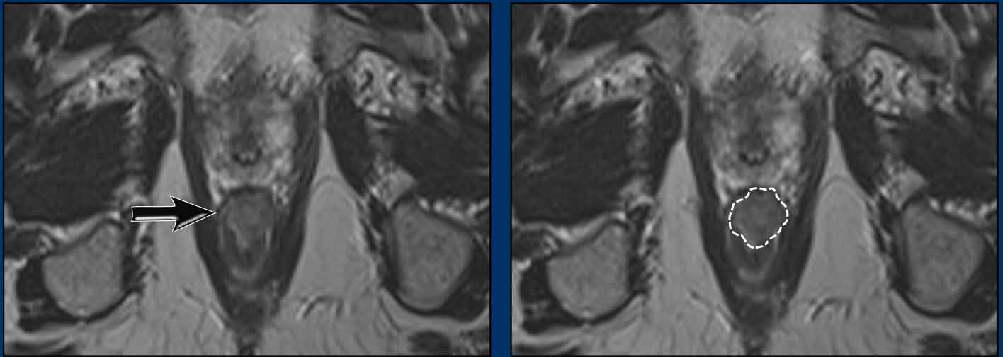 Anal cancer before chemoradiation