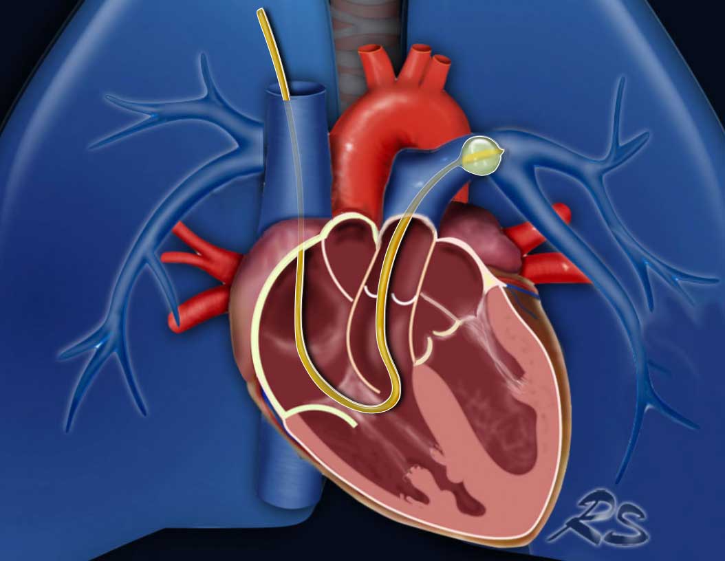 Swan-Ganz catheter inserted into the left pulmonary artery to measure the pulmonary arterial wedge pressure (PAWP).