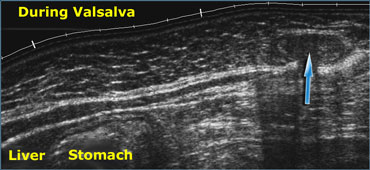 Realtime US allows to observe the effects of Valsalva manoeuvre. Intra-abdominal fat is pressed into the abdominal wall (arrow) through an epigastric hernia.