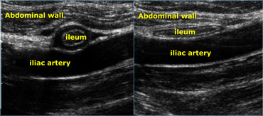 Realtime US allows to observe the effect of compression. Compare the contracted normal ileum (left) with the relaxed, flattened ileum in the same patient a few seconds later (right)