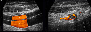 LEFT: The normal appendix is small, compressible, contains no Doppler signal, and is not surrounded by inflamed fat .RIGHT: The inflamed appendix is large, non-compressible and hypervascular, and is surrounded by hyperechoic, non-compressible tissue, representing the fatty mesoappendix