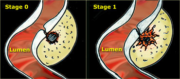 LEFT: The neck of the diverticulum becomes obstructed. Surrounding inflamed fat represents mesentery and omentum attempting to wall-off the imminent perforation. RIGHT: Development of a small paracolic abscess, successfully walled-off by mesentery and omentum.