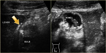 LEFT: In the right upper quadrant wall thickening of the duodenal bulb is found. There are both transmural and extramural (arrow) gasconfigurations. The inflamed fat represents mesenterial and omental fat (fat) attempting -in vain- to wall off the perforation. RIGHT: In the right lower quadrant a large amount of debris-like peritoneal fluid is found.