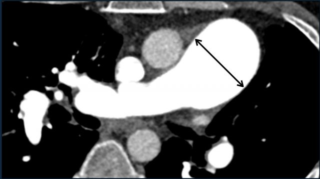 Pulmonary Hypertension and Thromboembolic disease