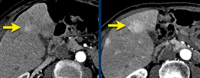 LEFT: Hyperenhancing observation detected in segment 5. RIGHT: follow up 3 months later shows growth.