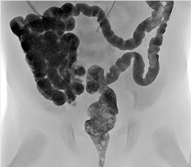 Microcolon: elongated colon with smalldiameter. It indicates that meconium has not reached the colon yet. Once the obstruction is relieved and bowel contents pass through the colon, the colon will develop normally without remaining consequences.